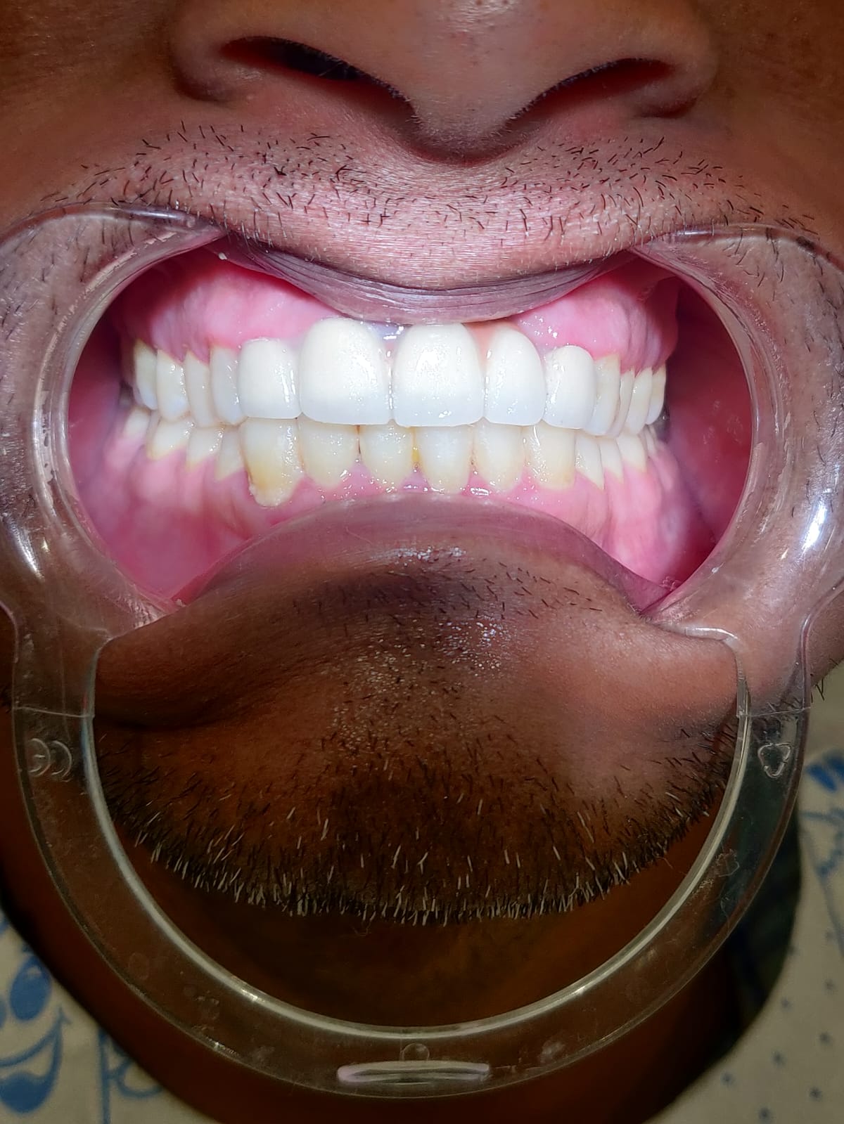 Patient smile after treatment at Ritual Dentistry