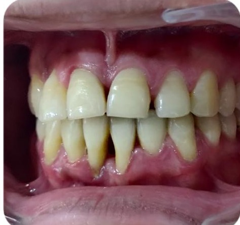 Patient smile before treatment at Ritual Dentistry
