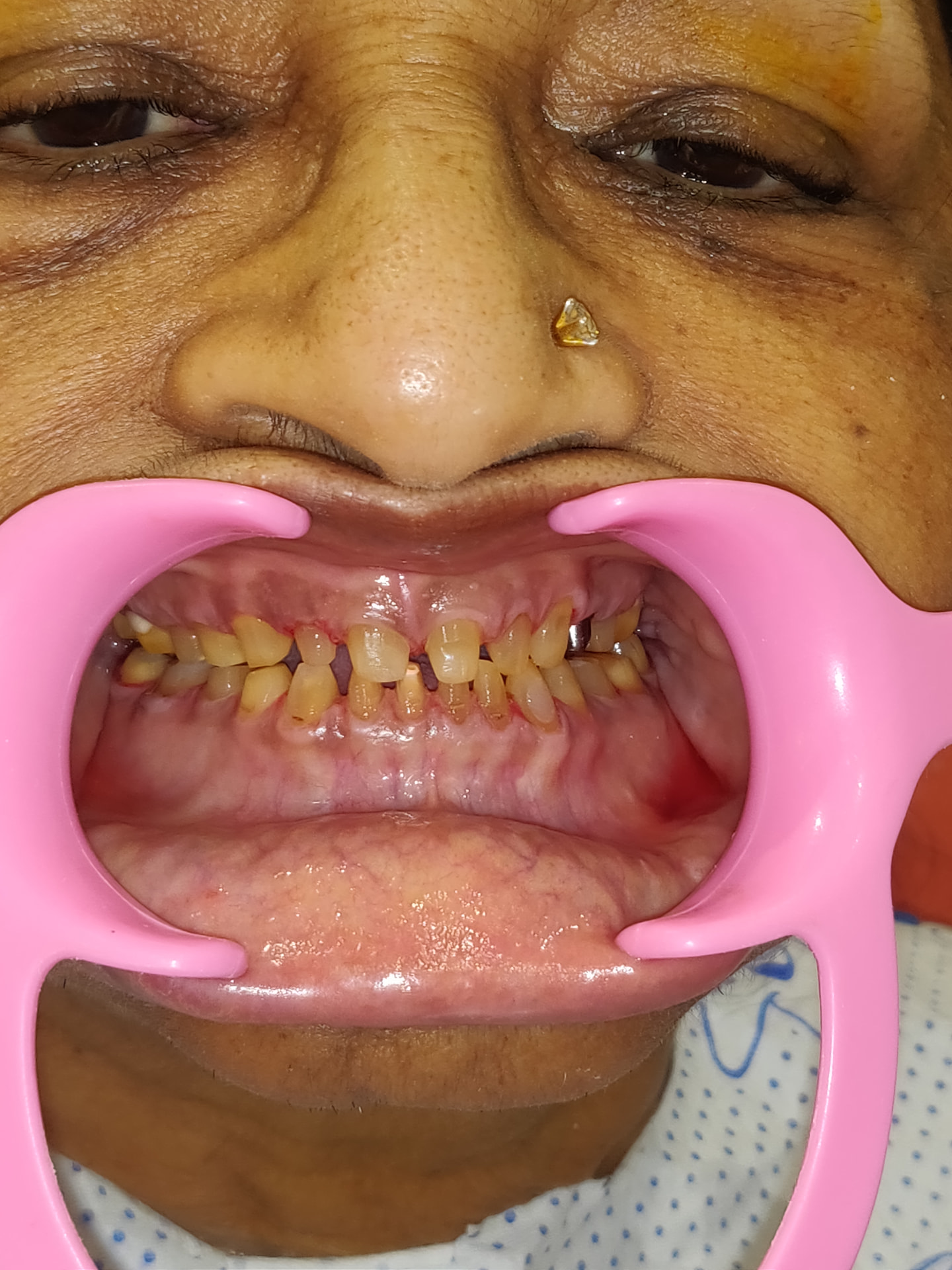 Patient smile before treatment at Ritual Dentistry