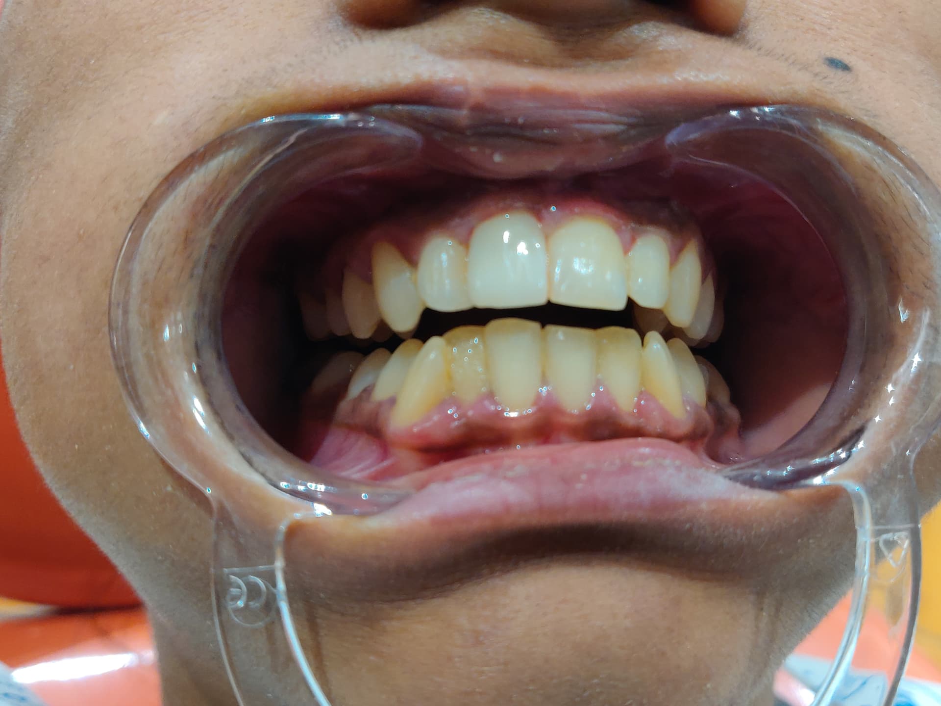 Patient smile after treatment at Ritual Dentistry
