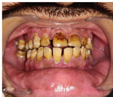 Patient smile before treatment at Ritual Dentistry